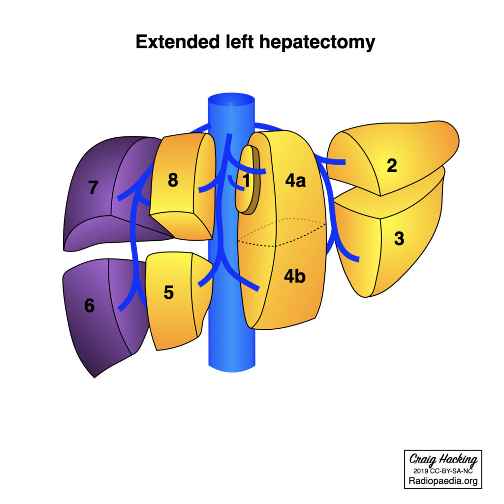 extended left hepatectomy