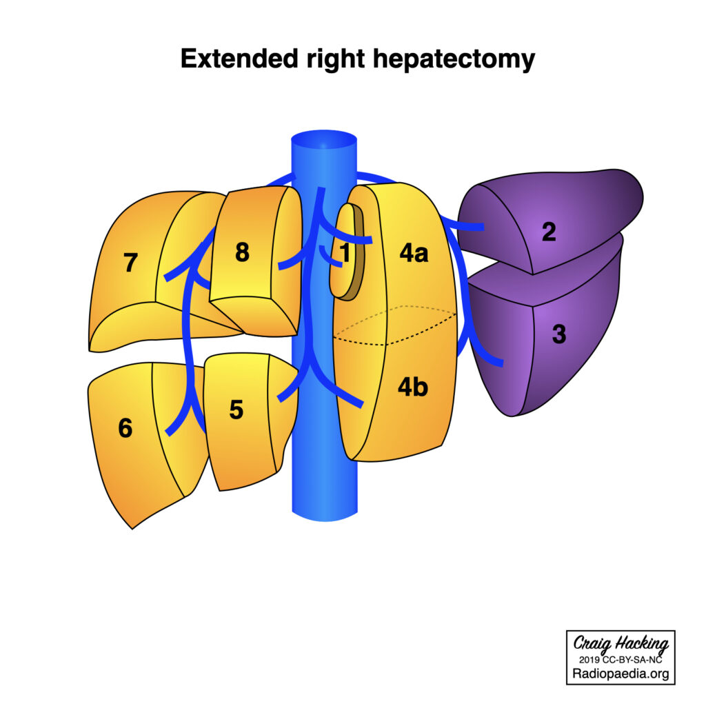extended right hepatectomy