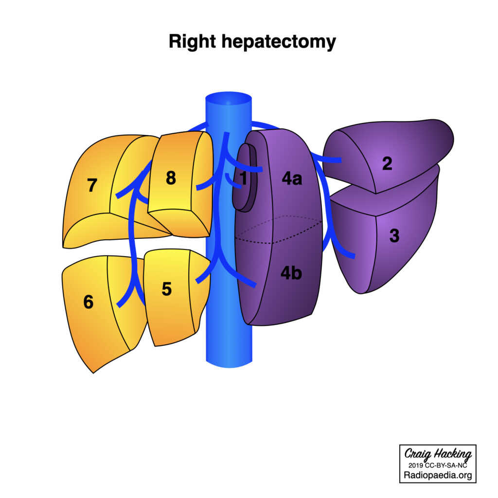 right hepatectomy
